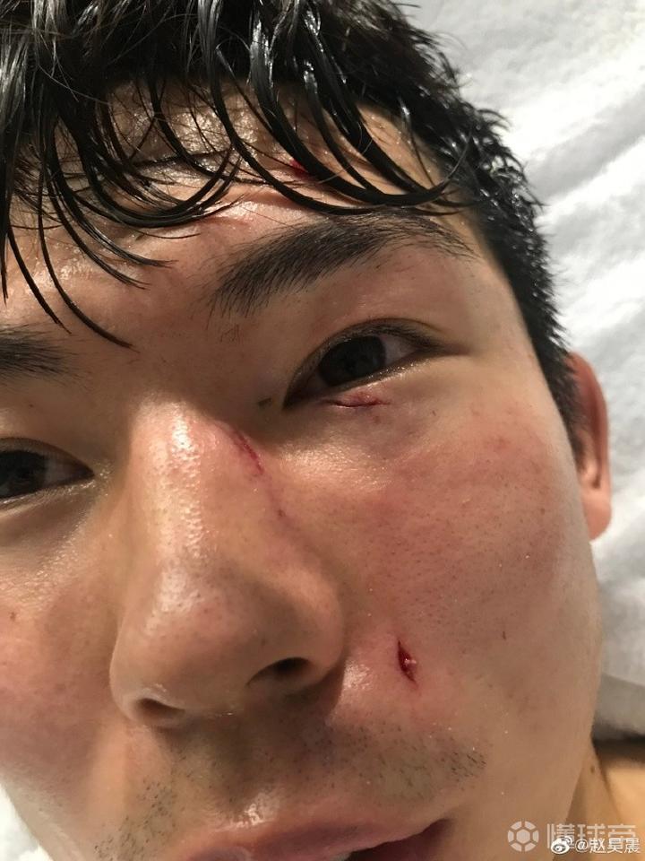 上港新闻官晒杨世元受伤照片:外伤令人触目惊心