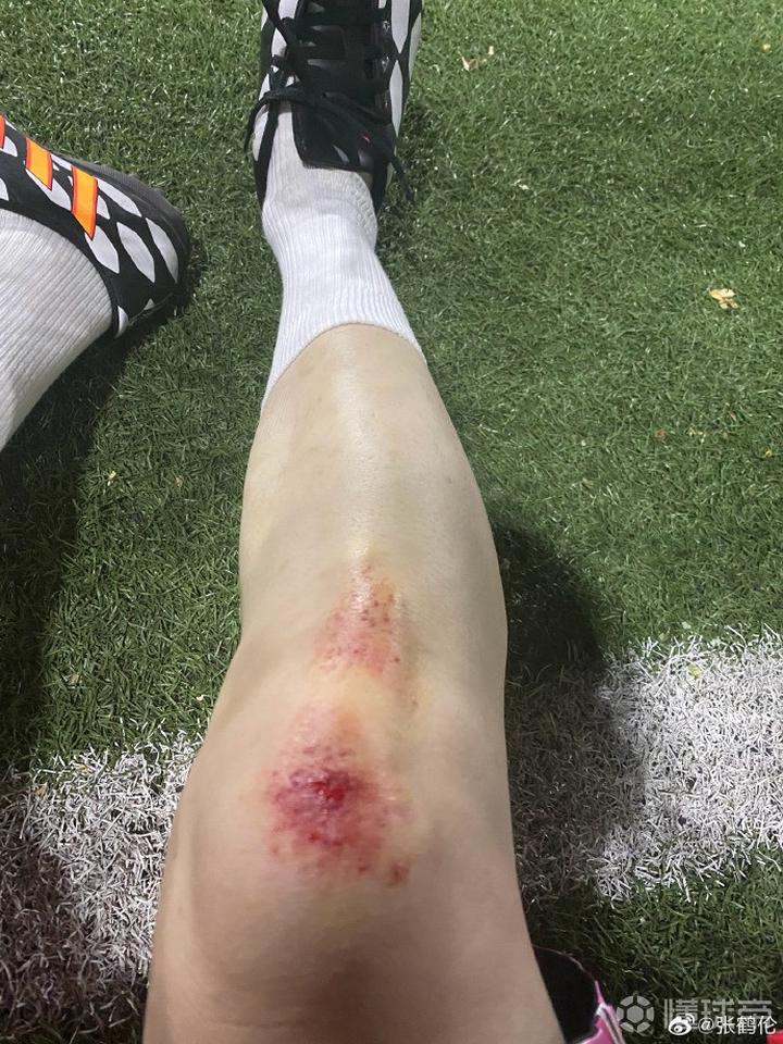 德云社演员张鹤伦踢球最后一场球又受伤了真悲催