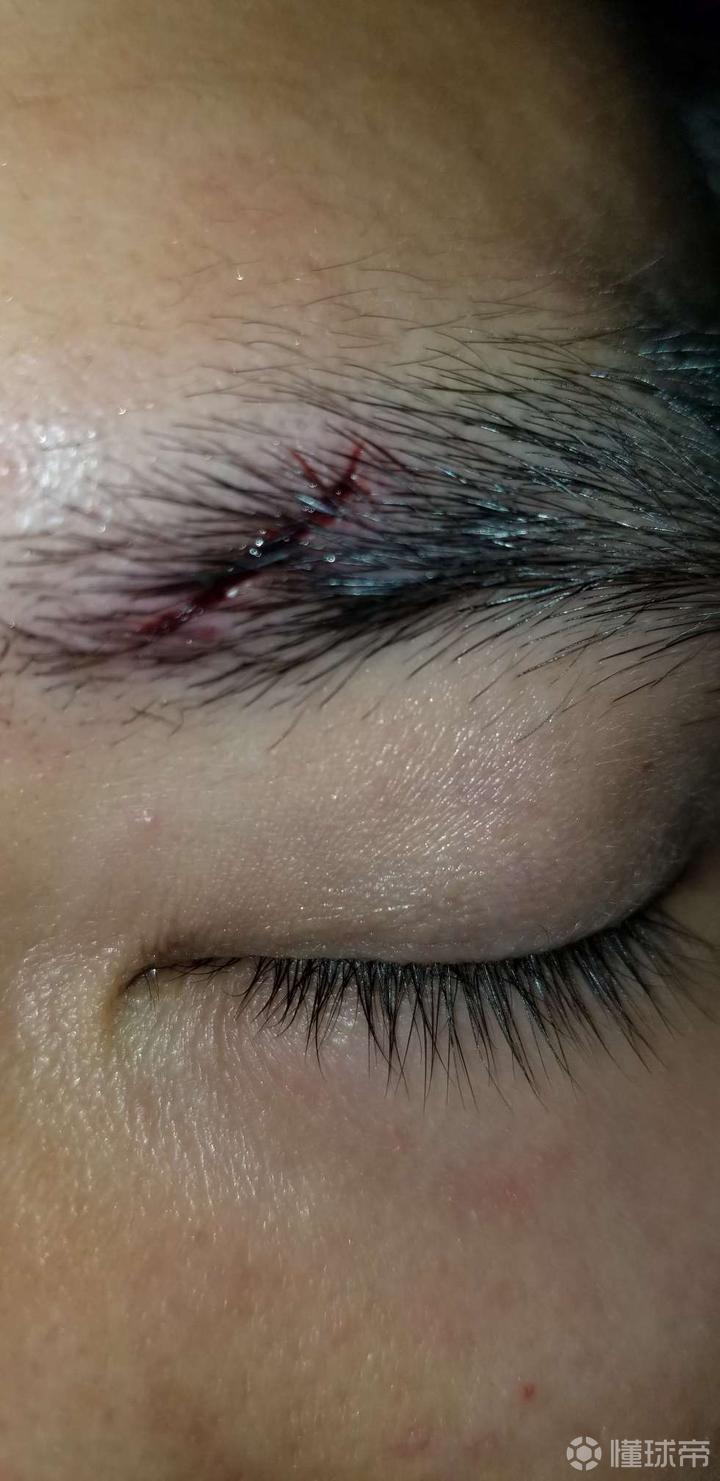 眉骨开了,但不深,不去缝针,会留一个很显眼的疤吗?